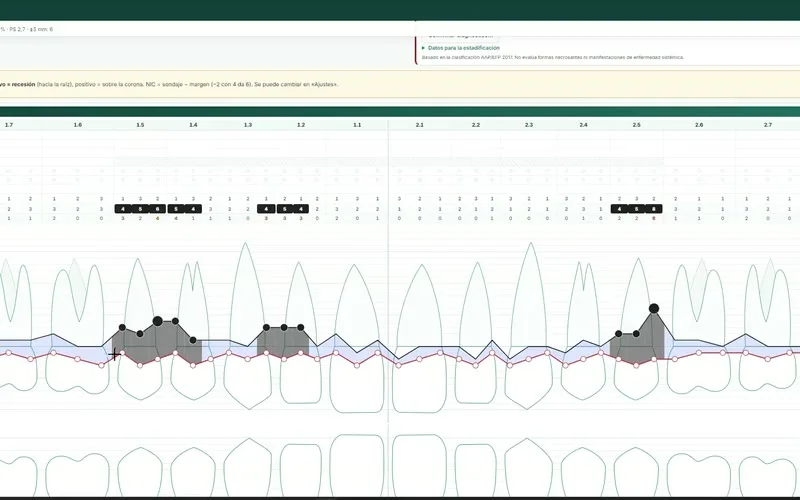 Periodontograma con la línea del margen gingival y el fondo de las bolsas dibujados sobre los dientes